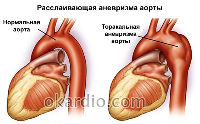 bilo cardiomagnil hipertenzije hipertenzija u petrozavodsk