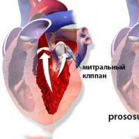 When the valve fails: mitral stenosis, methods of treatment and prevention of this pathology of the heart