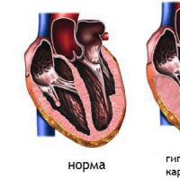 Trasplante de corazón (trasplante): ¿cuánto cuesta, qué es un corazón artificial y cuánto tiempo viven después de un trasplante?