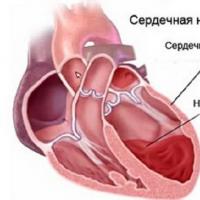 Znaki in metode diagnoze anevrizme aorte