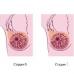 Mukózna rakovina prsníka Liečba koloidnej rakoviny prsníka