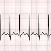 What does heart rhythm disturbance mean?