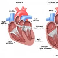 Povečanje levega prekata srca: možni vzroki in zdravljenje